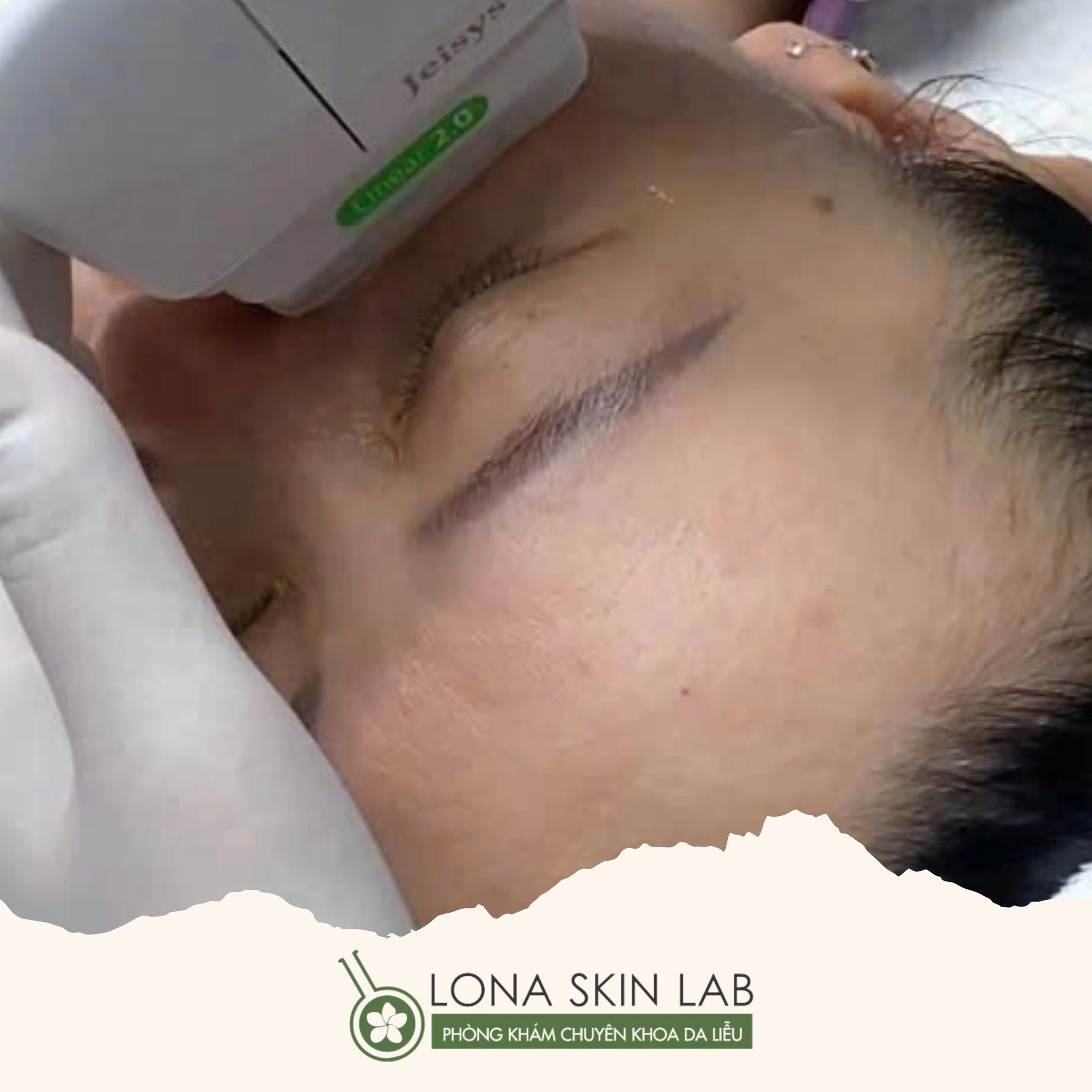 Với Glow Face 2.0, công nghệ HIFU được ứng dụng xuất sắc trong việc trẻ hóa da, thu nhỏ lỗ chân lông và tối ưu hóa liệu trình chăm sóc da cho kết quả hoàn hảo.