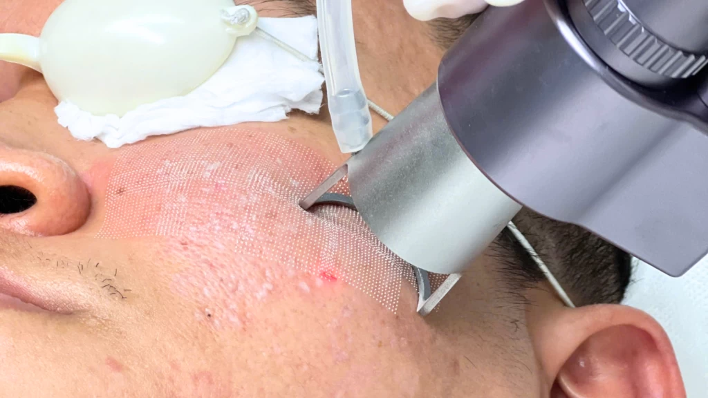 Điều trị sẹo rỗ